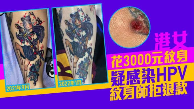 港女花3000元紋身疑感染HPV。網上圖片
