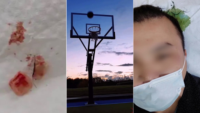 廣東男打完籃球6天後頭頂有腐臭味，就診竟發現2顆斷牙。