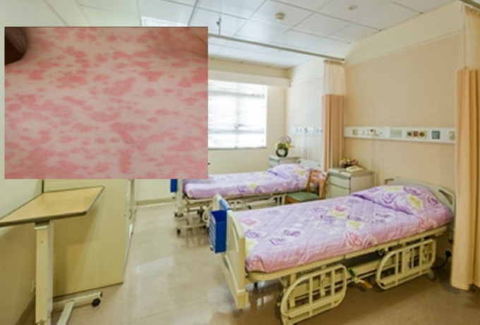 澳門鏡湖醫院7名醫護病人集體感染麻疹。網上圖片