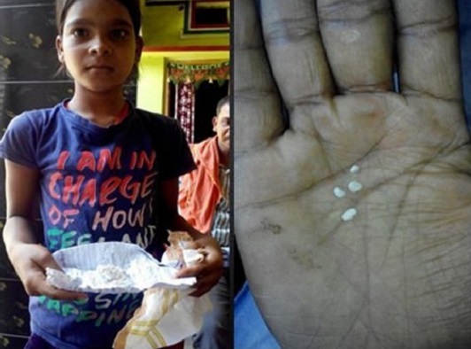 印度一名11岁女童双眼经常流出不明的白色分必物。 网上图片