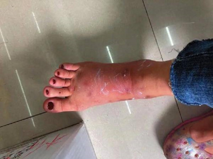 廣西南寧市民秦女士腳被紅火蟻蜇傷後紅腫痛癢。網上圖片