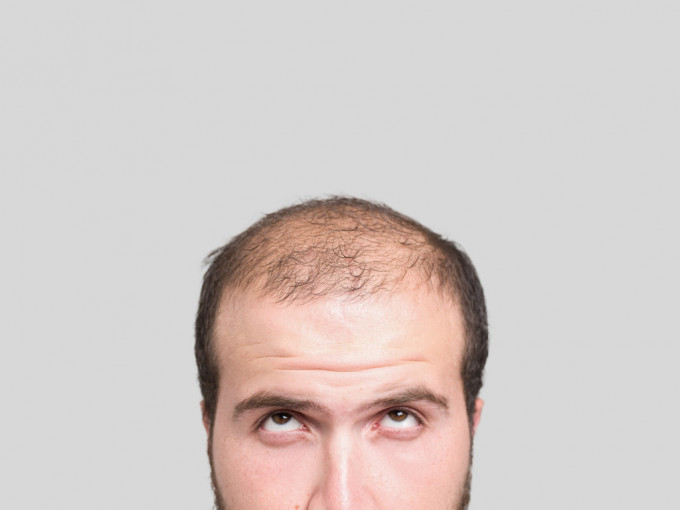 印度秃头男为「脱单」植发，术后竟引发过敏反应惨亡。