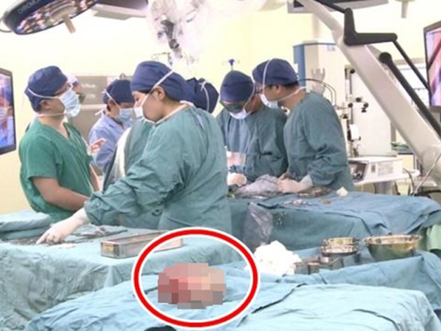 医生将直径约18厘米的巨型畸胎瘤除切。 网上图片