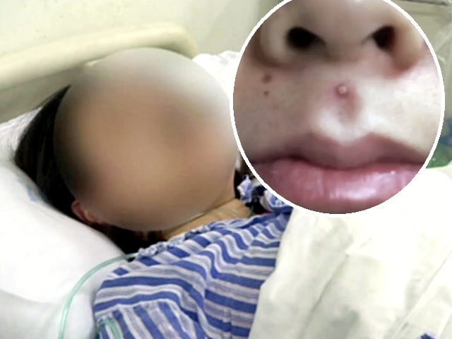 江苏一名少女因挤人中位的暗疮导致入院。网图