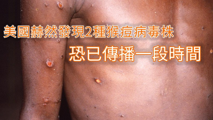 全球发现逾700宗猴痘病例。AP