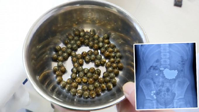 10歲男童吞下103顆鋼珠，醫生20多次只能取出92顆，還有十來顆殘留在腸道。