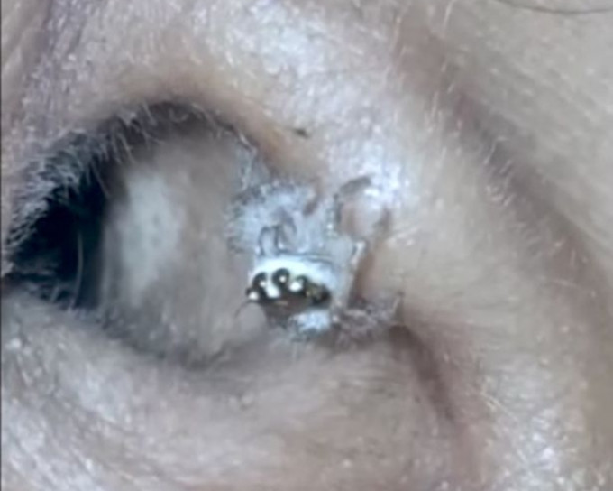 毛茸茸的蜘蛛从耳道中爬出来。网上图片