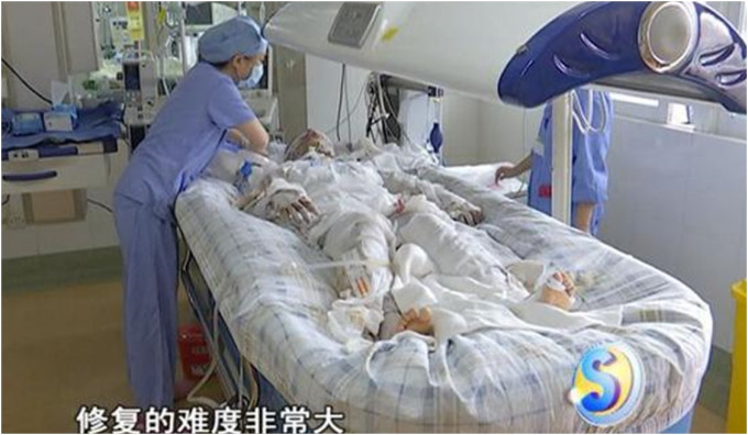 廣州17歲少女洗澡時煤氣爆炸。網上圖片