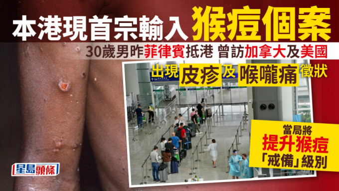 香港现首宗猴痘输入个案。