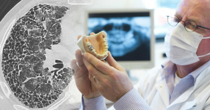 美國研究發現牙醫患特發性肺纖維化疾病，較其化人多23倍。網上圖片