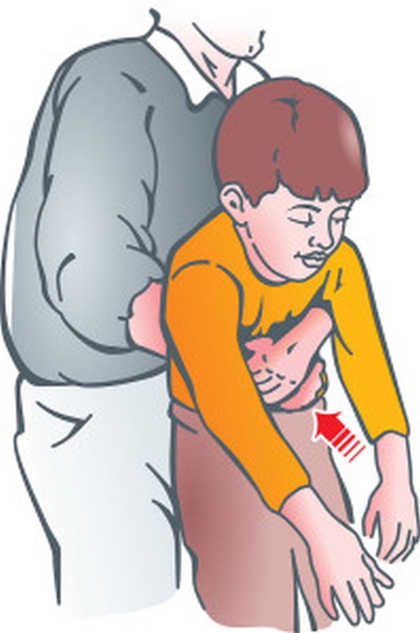 哈姆立克急救法（Heimlich Maneuver）在全世界被廣泛應用（如圖所示），靠著這個擁抱拯救了無數患者，因此該法被人們稱為「生命的擁抱」。(網圖)
