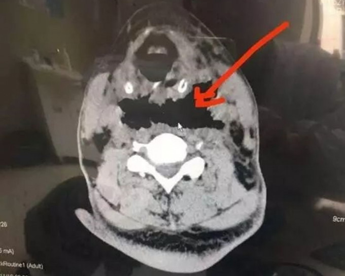 头颈部CT显示，马女士的咽后壁及咽旁间隙被食肉菌吃掉。(网上图片)
