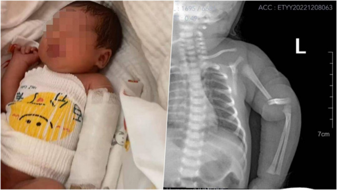 男嬰出世僅一天被發現手臂骨折，夫婦哭訴最希望兒子能夠完全康復。網圖