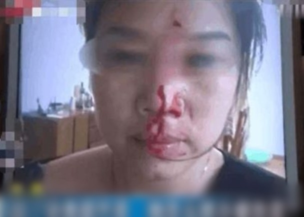 张女遭江姓送餐员殴打至头破血流。（网图）