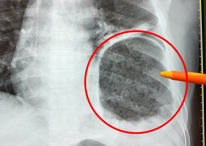 台湾一名直肠癌男病人胃冲进胸腔。网上图片