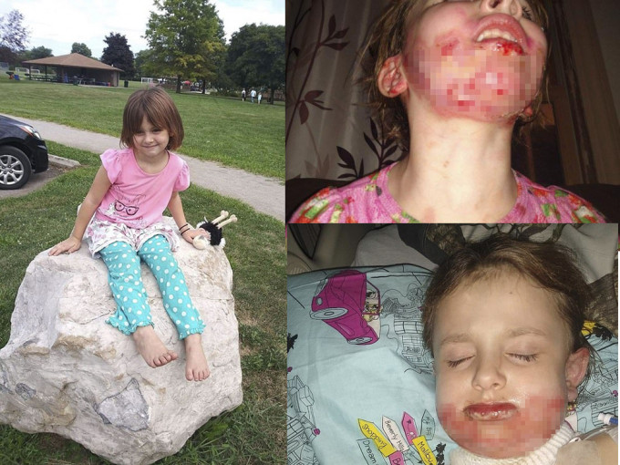 美國6歲小女孩用搓手液，同伴玩打火機造成搶火，女童臉部灼傷。