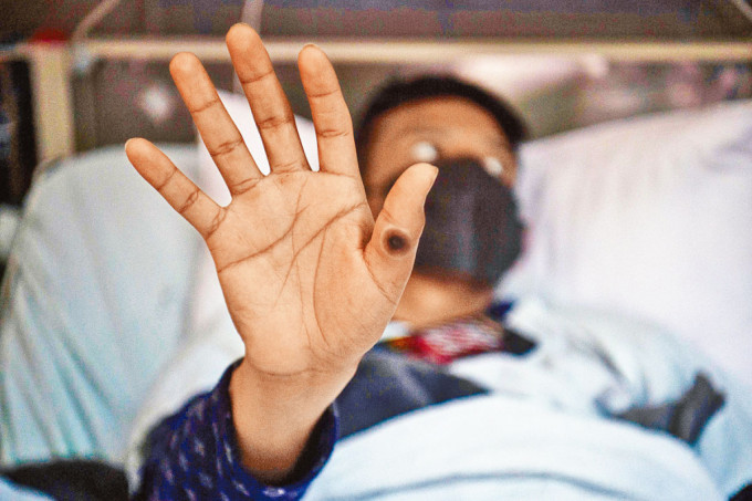 秘魯首都利馬的猴痘患者，展示手上的瘡。