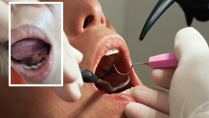 女生早前到牙医诊所拔牙，随后竟在舌头下发现有一个大洞。示意网图/「爆料公社」FB