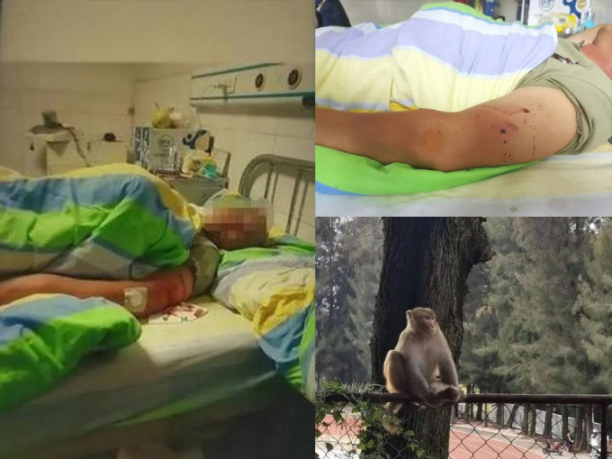 被群猴圍攻的男子左臂和左腿多處被猴子抓傷、咬傷，腰椎一二節因摔倒致壓縮性骨折。(網圖)