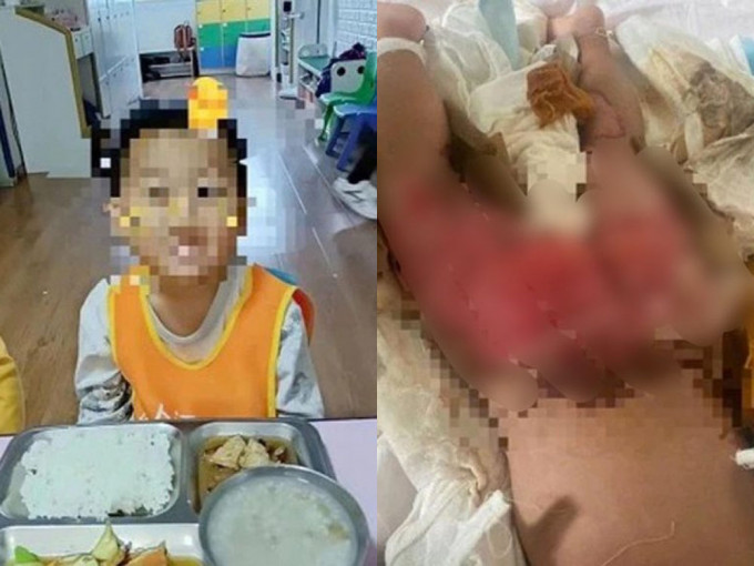 3岁男童意外跌进汤桶22％烫伤。