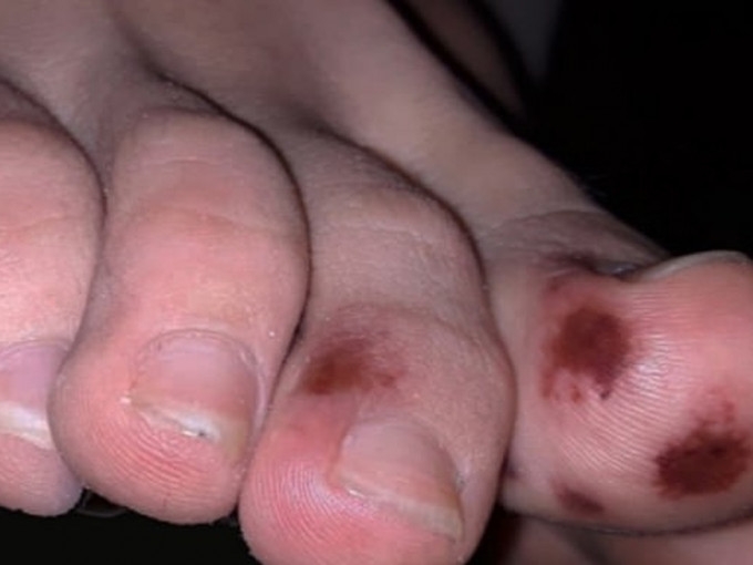 西班牙一個醫療研究小組表示，類似於水痘的腳趾疼痛可能是新冠病毒的一種新的特殊症狀。(網圖)