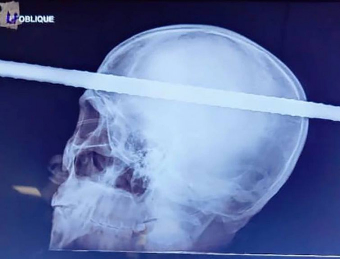 X光显示，钢筋已插穿大脑。网上图片