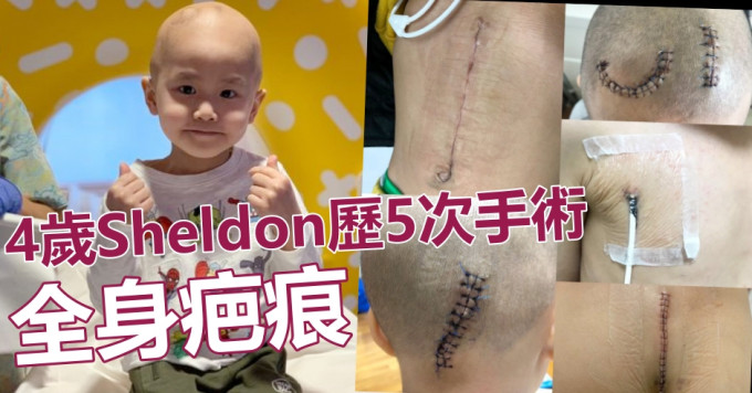 4岁Sheldon历5次手术全身疤痕。FB图片