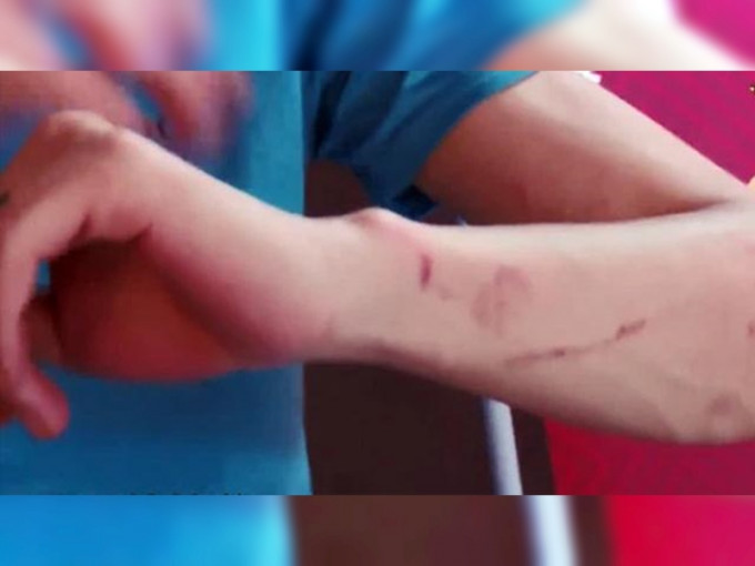 长沙有学生游玩密室逃脱后，手臂上全是伤。网图