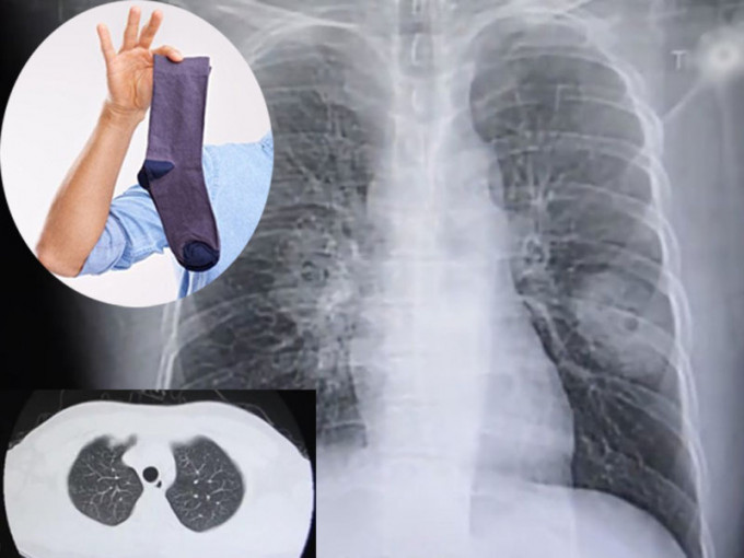 福建漳州一名男子肺部受真菌感染愈趨嚴重，他自爆有聞臭襪的癖好。（網圖）