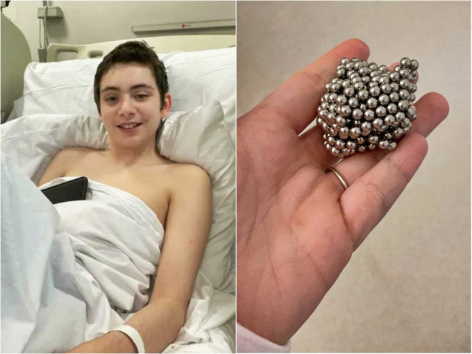 英國一名男孩為做實驗，竟吞下54粒小磁珠，差點送命。網圖