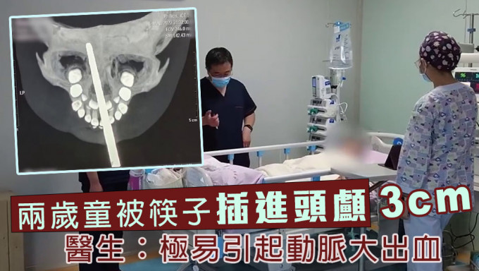 兩歲童摔倒筷子插進顱內3厘米，醫生：差點動脈大出血。