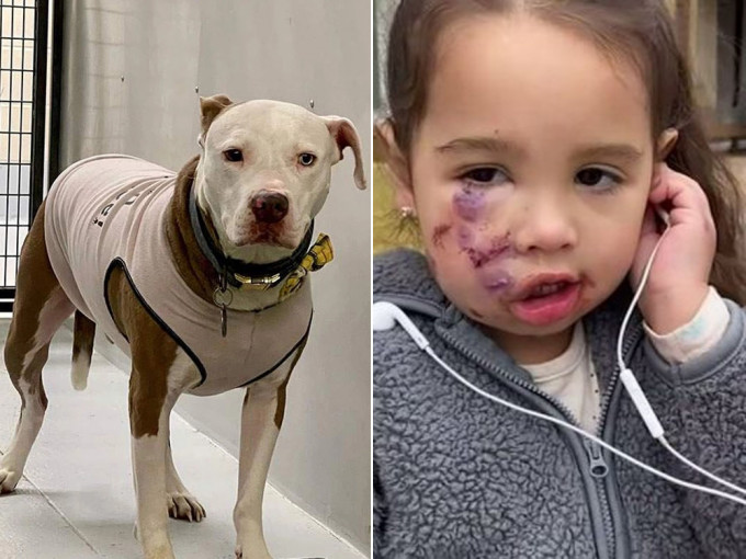 3歲女童被狗咬傷，狗主不顧而去，女童送院後縫15針日後需整形。（網圖）