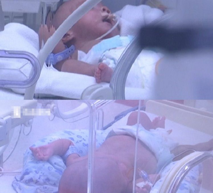 晚生12天的双胞胎弟弟幸运地存活下来（网上图片）
