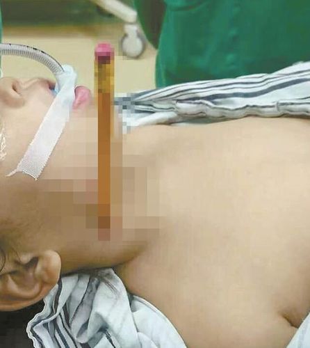 铅笔插入女童的右颈。图：医院提供