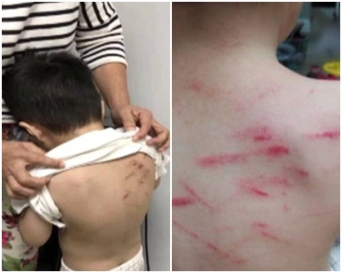 男童父親在兒子的右後肩上發現20多條長短不一的傷痕。網上圖片