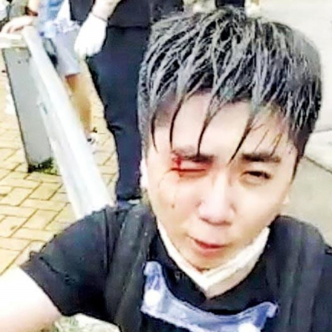 杨子俊在去年反修例冲突中右眼受伤。网图