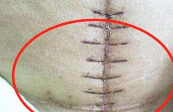 丈夫情急下掀起妻子的上衣，發現她剖腹生產後，肚皮留下明顯的「蜈蚣疤痕」。孕育乖寶寶圖片