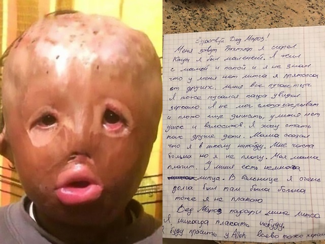 辛卓夫在一场意外中，其脸部被严重烧伤致毁容。网上图片
