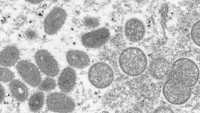 猴痘变异速度比预期快12倍。AP资料图片