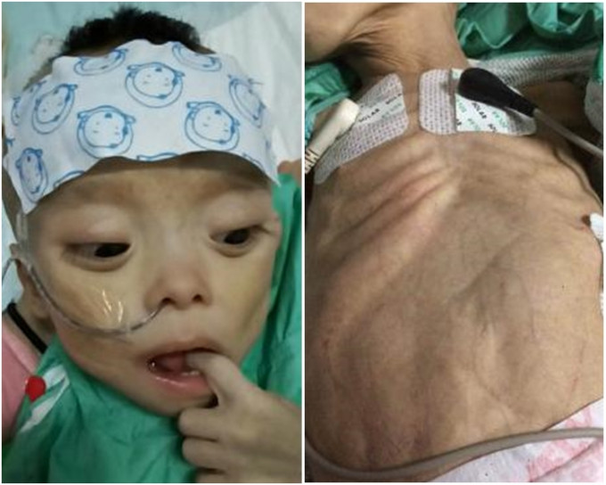 重庆巫溪1岁男婴黄洁宇患上怪病，1年中每日腹泻10-30多次，眼珠突出、胸腹瘦如树皮。网图