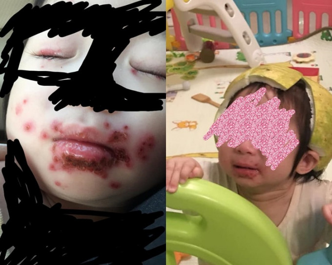 一名台湾女网友日前表示自己的妹妹因食家人「口水尾」染上疱疹。网图