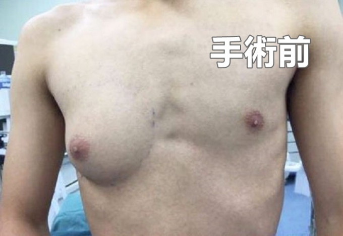 浙江男生小杨，自13岁起左右两边乳房发育开始不平衡。网图