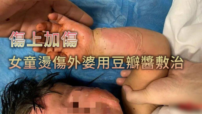 女童左手腕部傷勢嚴重有可能會影響生長發育。網圖