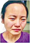 ■廣州一名女護士被外籍患者咬傷。