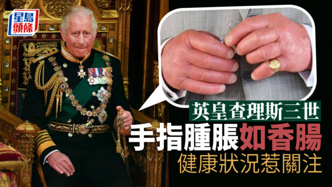 网络疯传英皇查理斯三世「香肠手」照片。