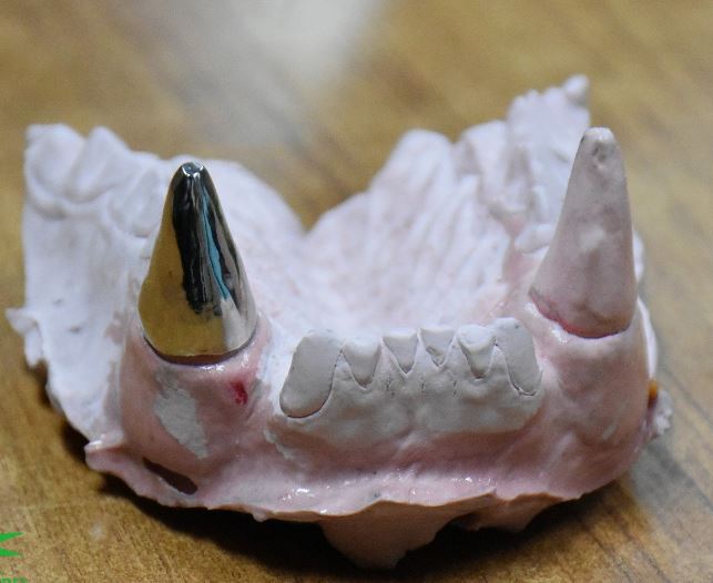 園方特別選用目前堪稱最堅硬的鈦金屬來製作牙套。