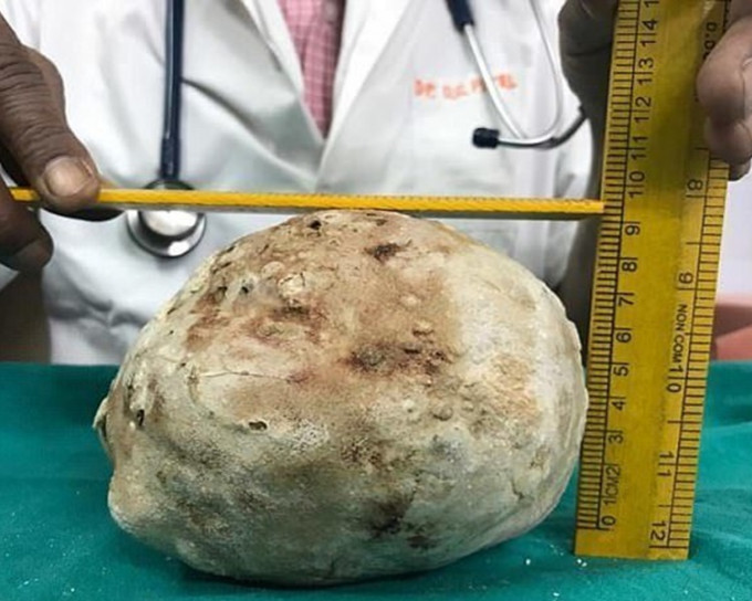 印度男膀胱結石1.4公斤。網上圖片