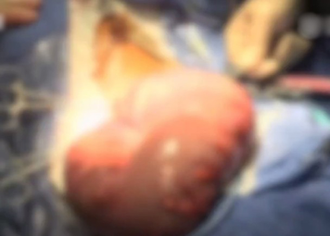 醫生替男童開刀時，取出重達3公斤的「肉球」。 網上圖片