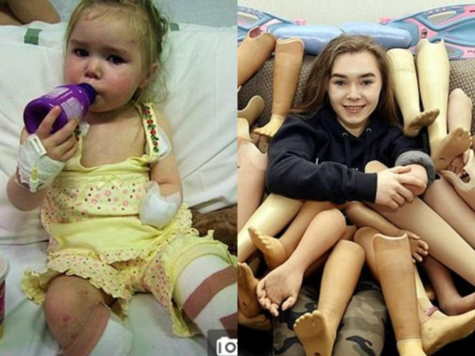 15岁少女奥莉维亚捐出25对义肢。网上图片