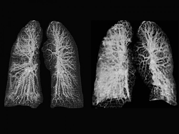 遊意大利湖北武漢，二人肺部X光片近日曝光，可見其肺部出現磨砂玻璃狀影像。(網圖)